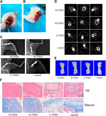 Total Flavonoids of Rhizoma Drynariae Promotes Differentiation of Osteoblasts and Growth of Bone Graft in Induced Membrane Partly by Activating Wnt/β-Catenin Signaling Pathway